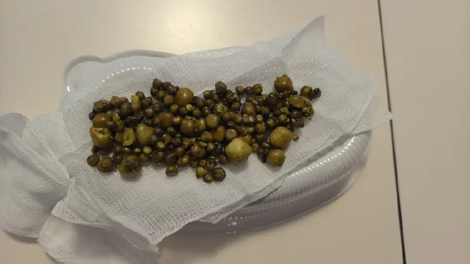 77 yaşındaki kadının safra kesesinden çıkarıldı: Tam 213 adet