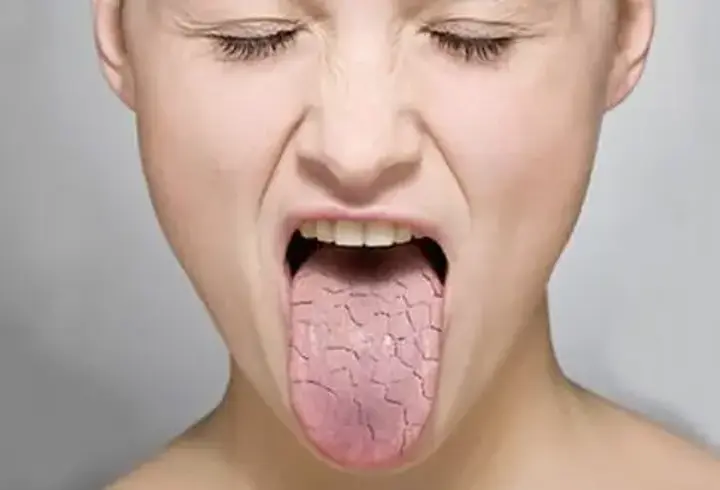 Sjögren Sendromu Nedir, Belirtileri Nelerdir? Sjögren Sendromu Tedavisi Nasıl Yapılır?