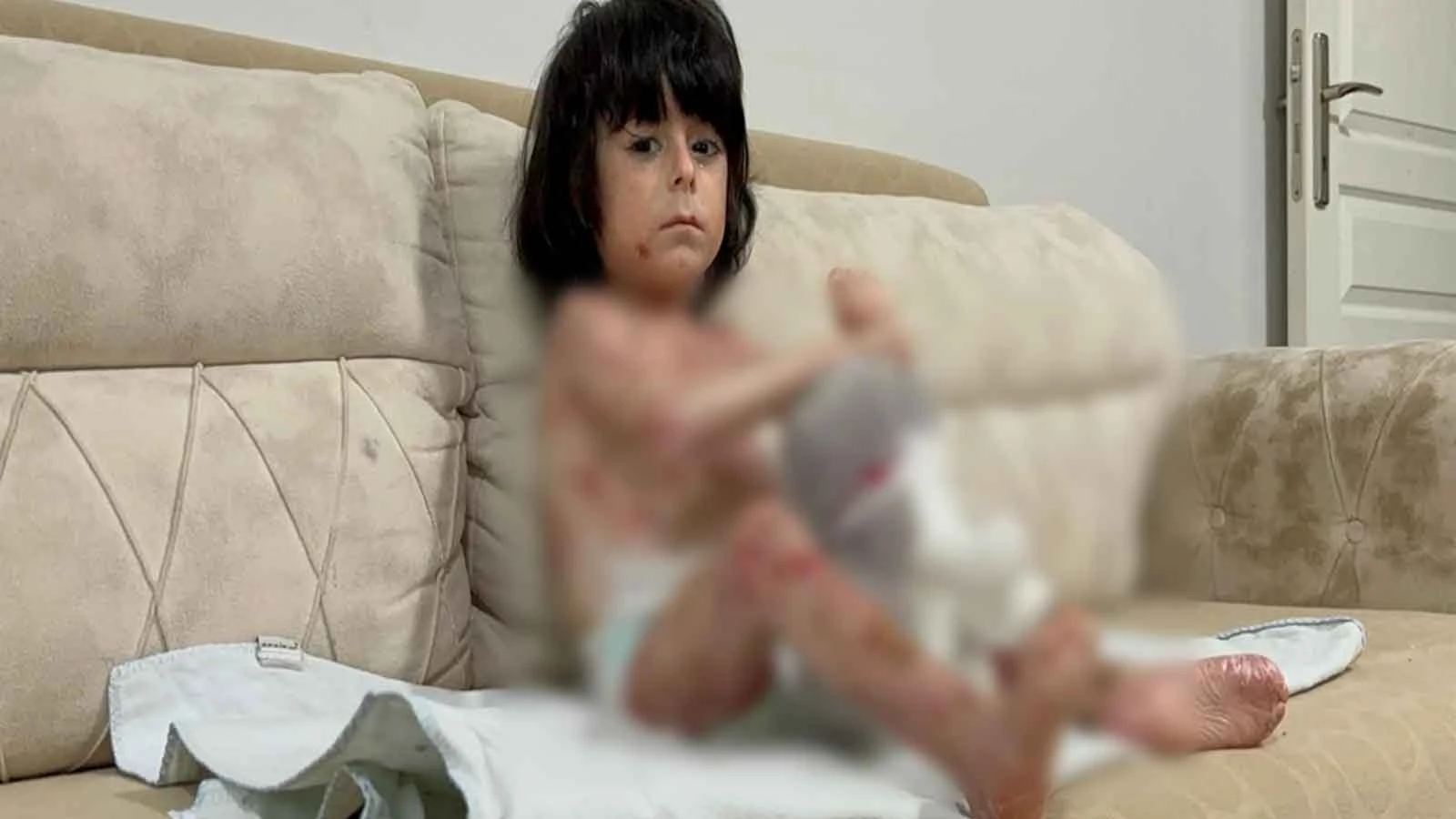 4 yaşındaki İbrahim, 'Kelebek hastalığı' nedeniyle kıyafet giyemiyor