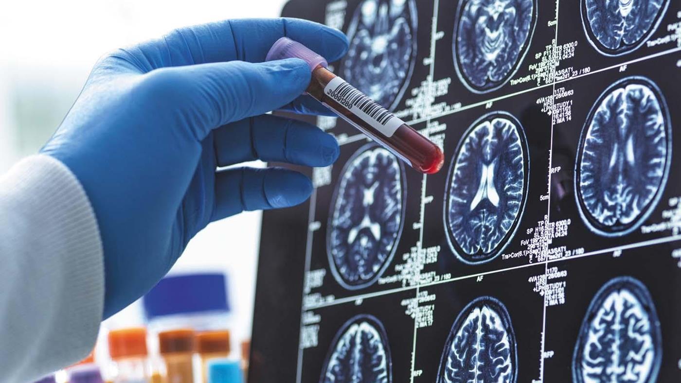 Basit bir kan testi Alzheimer’ın ilerleyişini yıllar öncesinden öngörebiliyor