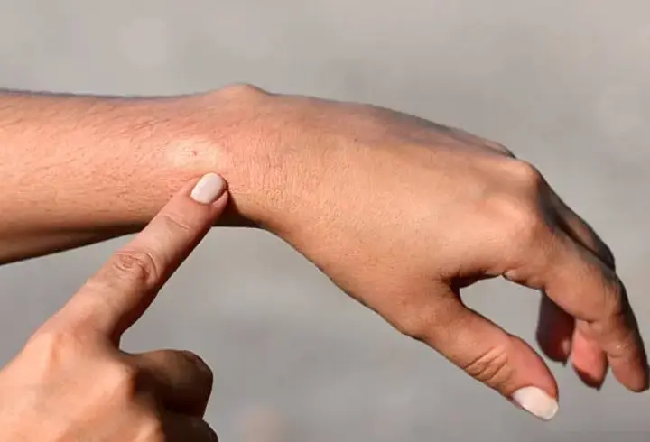 Arı sokmasına bağlı alerjik reaksiyonlar ölüme sebep olabilir