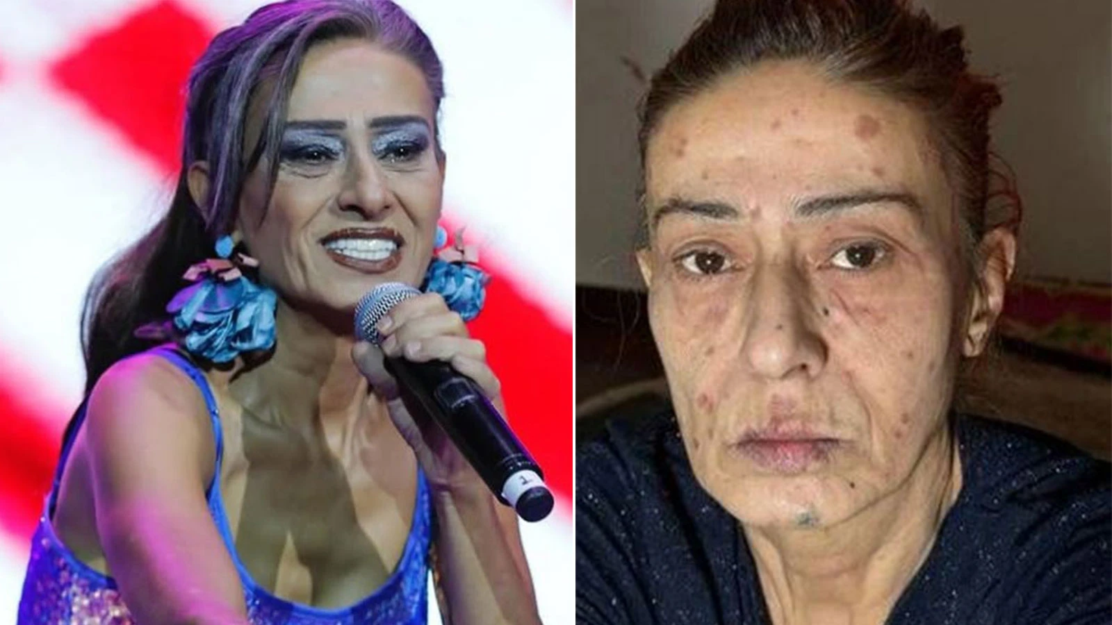 Yüzünde yanıklar oluşmuştu! Yıldız Tilbe son durumunu anlattı