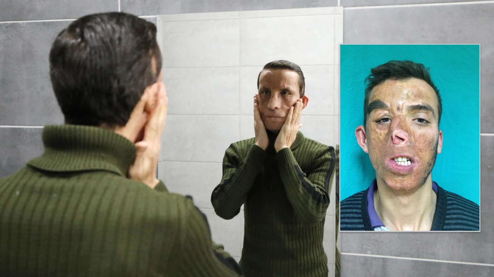 14 yıldır hayata başka bir yüzle bakıyor: Şu an onun yaşındayım