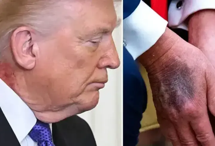 Önce eli şimdi de boynu: Trump'ın doktorunda açıklama