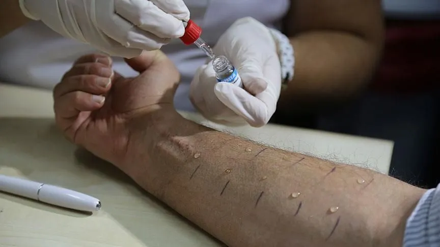 Türkiye'de toplumun yüzde 20'si alerjik belirtiler gösteriyor 