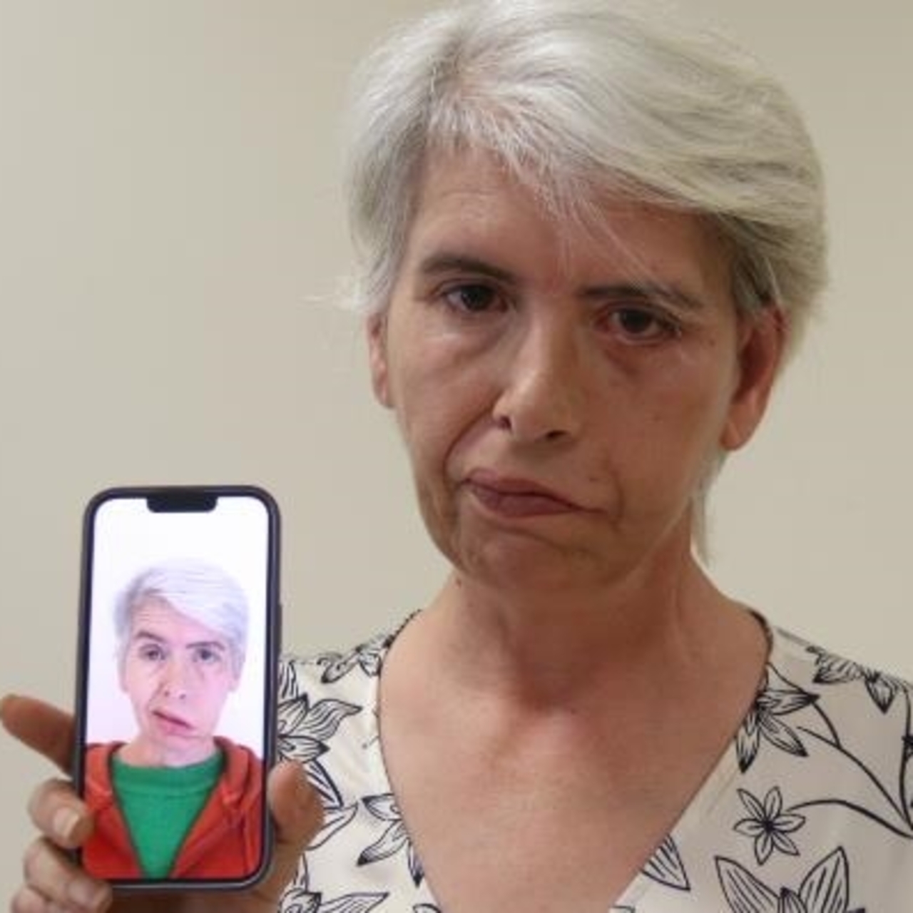 Yüz felci nedeniyle yıllarca açık gözle uyudu!