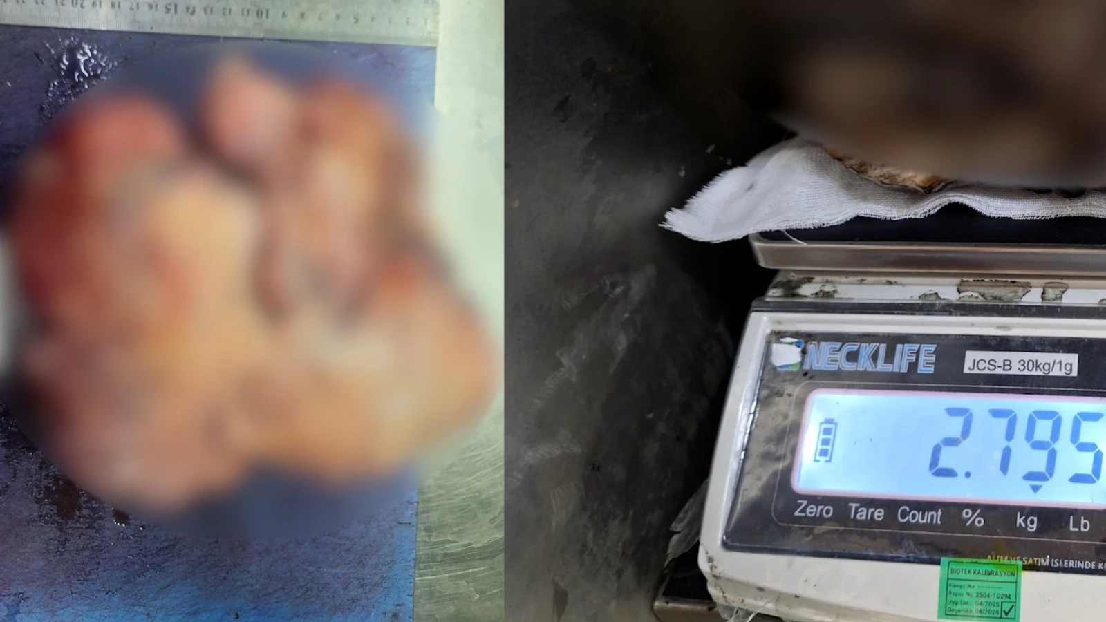 Nefes darlığı şikayeti ile hastaneye gitti, göğsünden tam 3 kilo çıkarıldı!