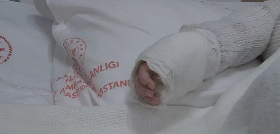 Üzerine kaynar su dökülen 20 aylık bebek taburcu edildi
