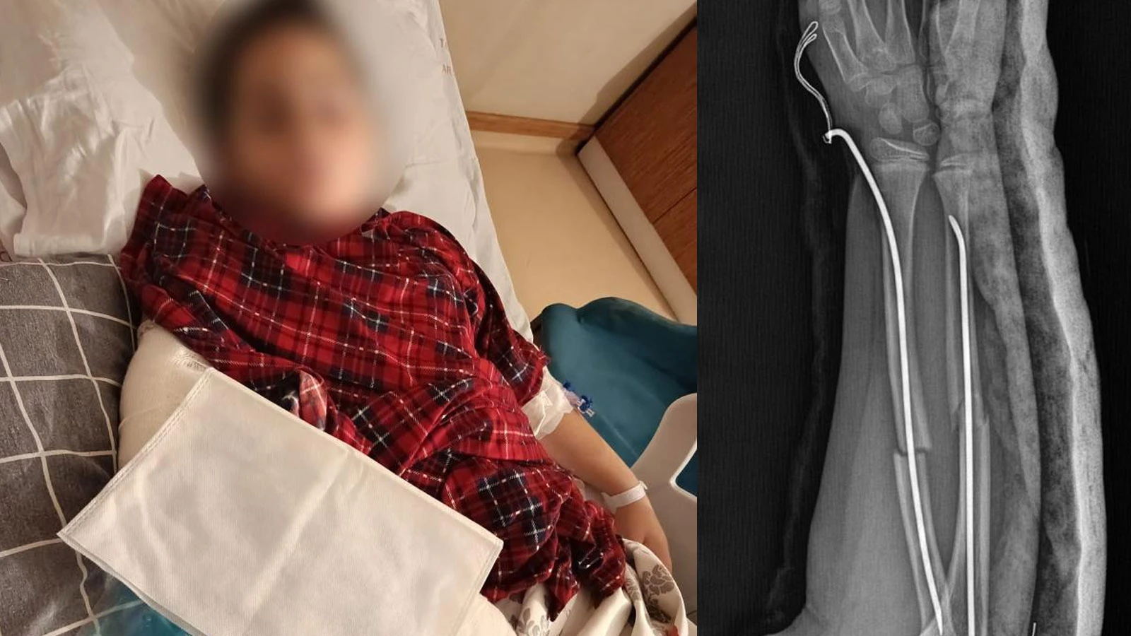 Büyükçekmece'de akran zorbalığı: Arkadaşının kolunu 2 yerden kırdı