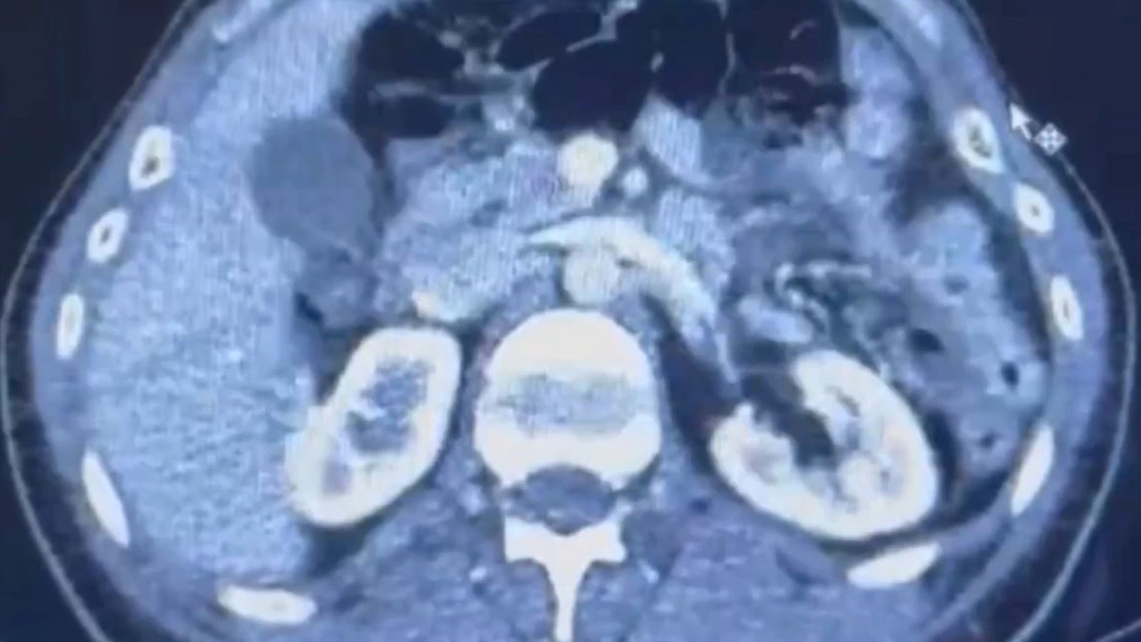 İranlı 3 şüphelinin midesinden 554 gram uyuşturucu çıktı