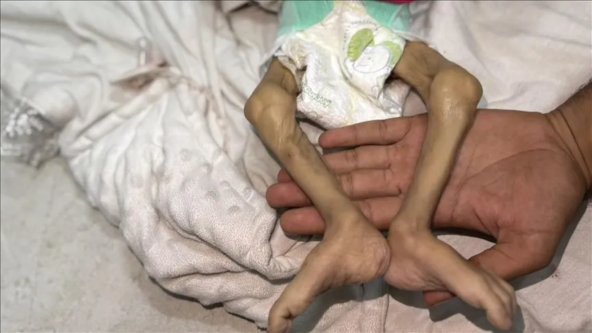 İsrail'in kıtlığı dayattığı Gazze'de bir bebek daha açlıktan can verdi