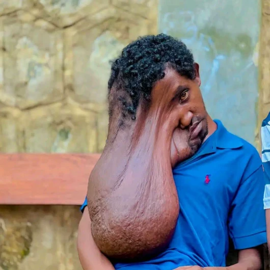 Doktorlar Bile İnanamadı: Etiyopya'da 22 Yaşındaki Hastanın Yüzünden 10 Kiloluk Tümör Çıkarıldı