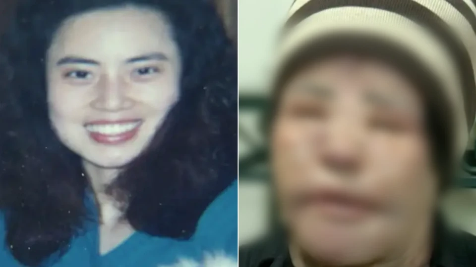 Güzelleşme Uğruna Hayatı Karardı: Doktorlar Ameliyatı Reddetti, Yüzüne Yemeklik Yağ Enjekte Etti